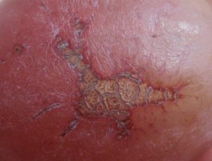 Health topics - scabies_infection