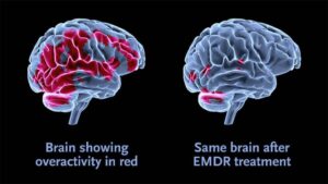 After Effects of EMDR